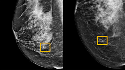 AI in breast cancer screenings
